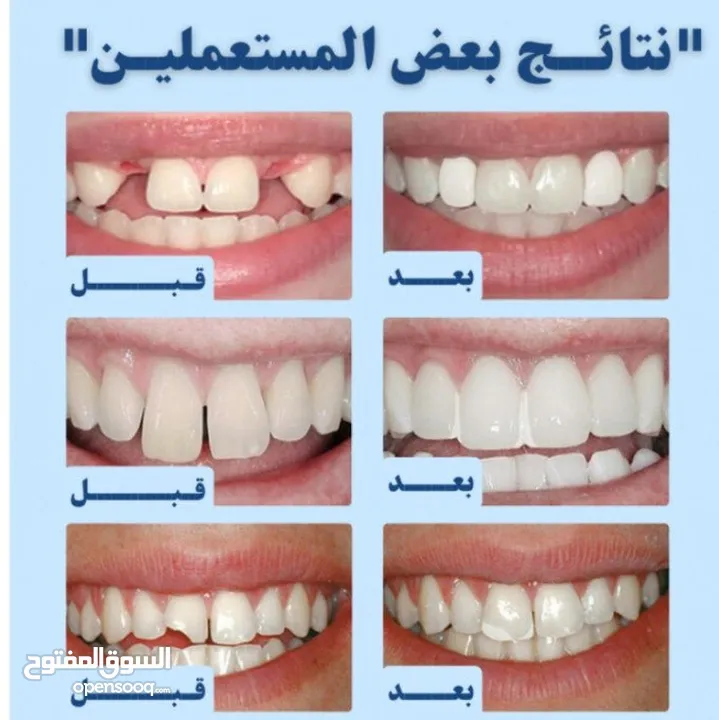 حشوه اصلاح الاسنان مؤقته للي يعاني من الالم حفرة داخل الاسنان او اصلاح كسر الاسنان