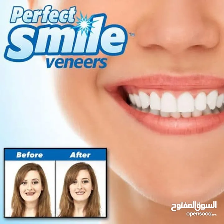 قشور تجميلية للفك العلوي perfect smile veneers