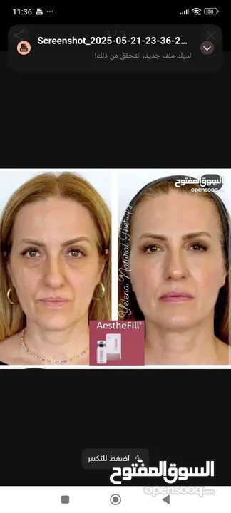 إبرة AestheFill الأصلية لتحفيز الكولاجين – بديل الفيلر والبوتوكس