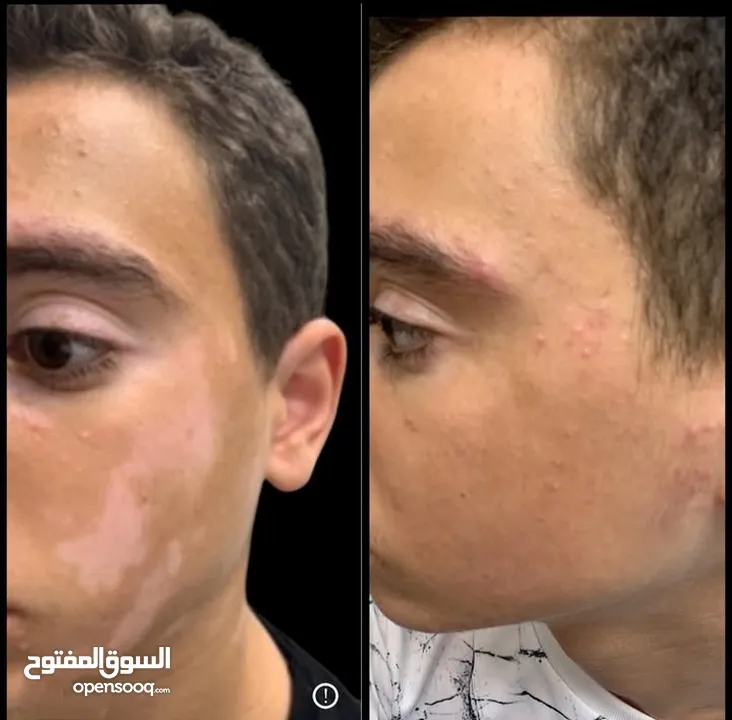 البهاق وطرق علاجيه تساعد بتوحيد لون البشره ومعالجة البهاق
