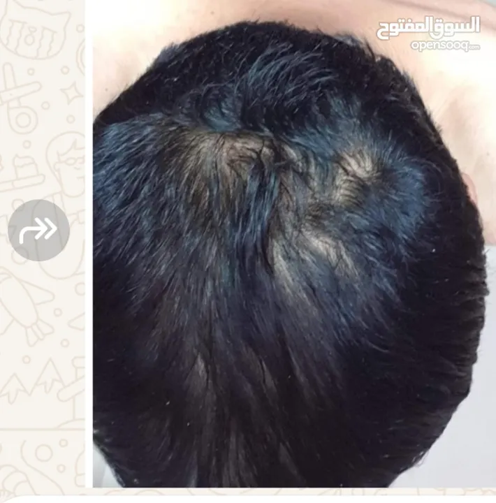 minoxidil منتج منع الصلع ونمو الشعر واللحيه