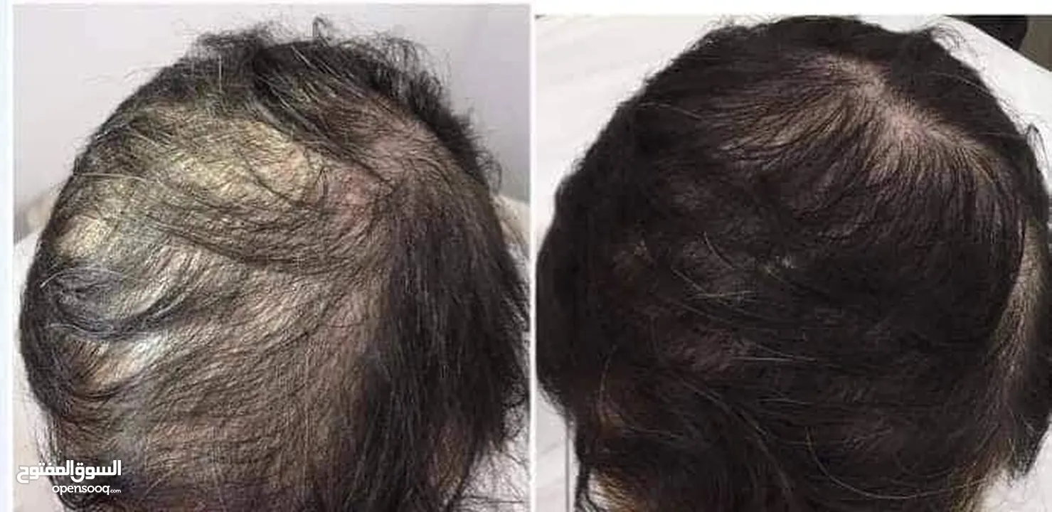 هام للرجال والنساء ودع تساقط الشعر الفراغات الصلع الوراثي بديل زراعة الشعر