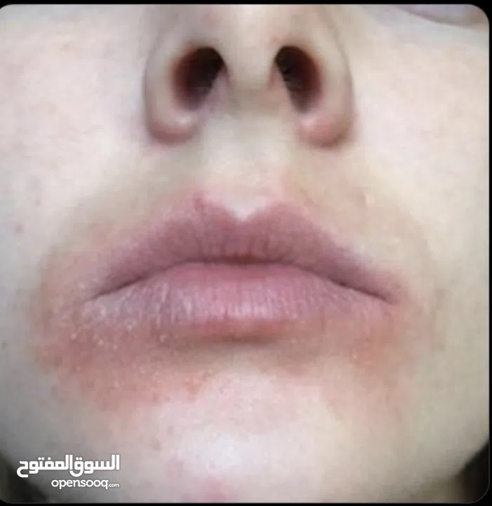 خلطة للتحلص من الاكزيما