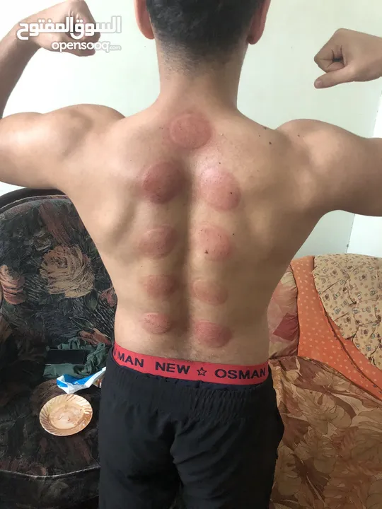 جلسات علاج بالحجامة  Cupping Therapy Sessions