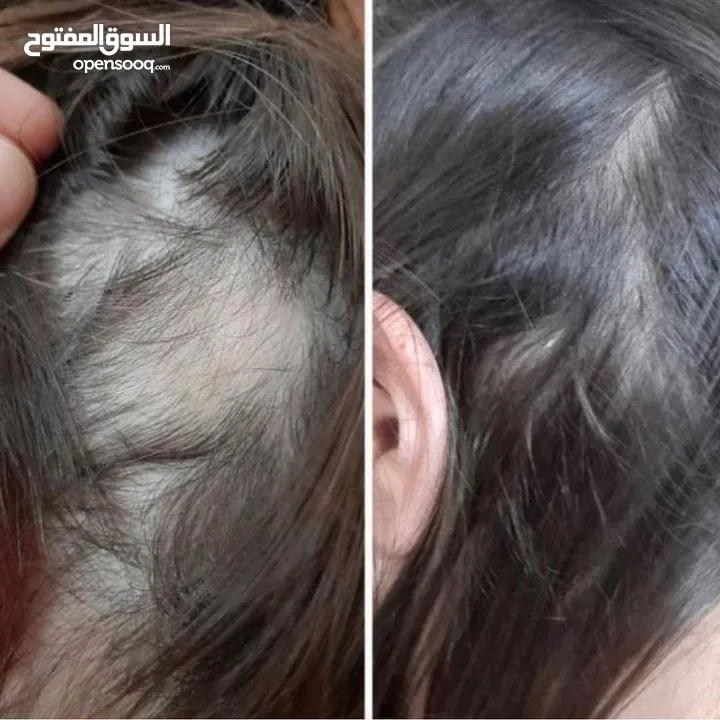 هام للرجال والنساء ودع تساقط الشعر الفراغات الصلع الوراثي بديل زراعة الشعر خلال 15 يوم شعر كثيف