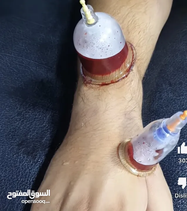 الاعلان عن خدمة تمريض بمزاوله مهنه وخدمه حجامه علاجيه