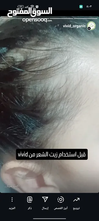 كريم ازالة التصبغات والكلف نتائج مضمونه 100%