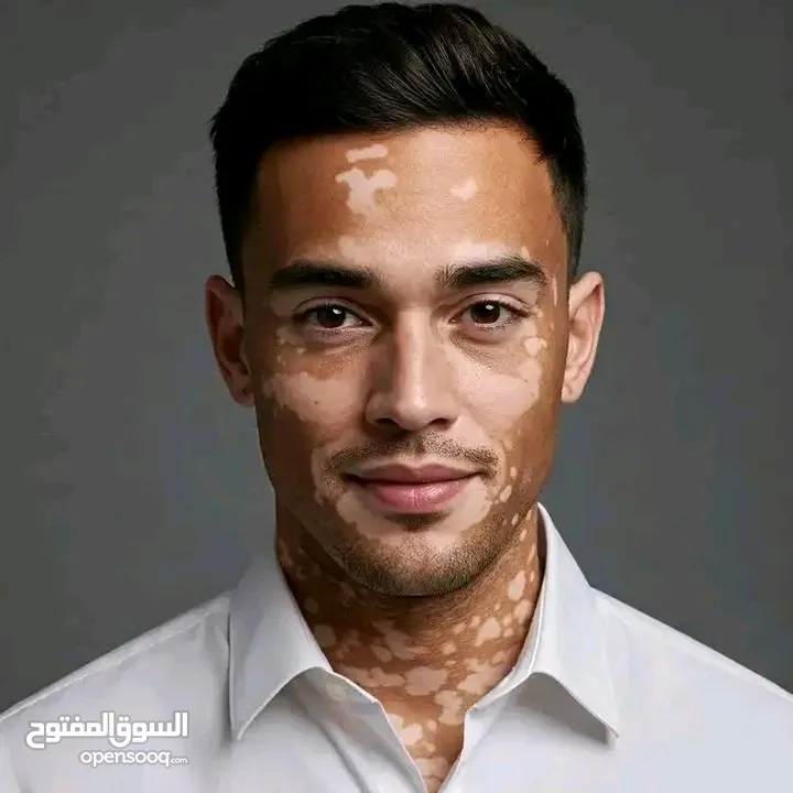 البهاق وطرق علاجيه تساعد بتوحيد لون البشره ومعالجة البهاق