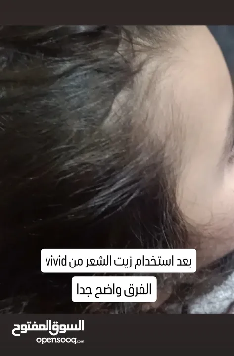 كريم ازالة التصبغات والكلف نتائج مضمونه 100%