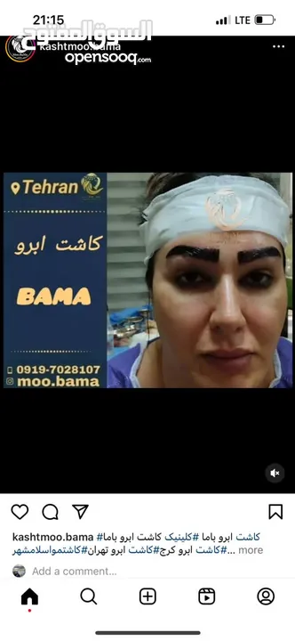 زراعة الشعر الطبيعي في ايران طهران