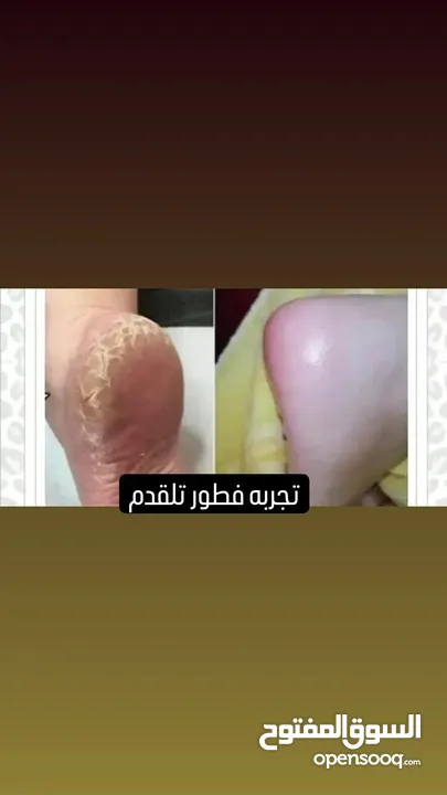 عناية بلبشرة والشعر اخصائيه تجميل علاج كل مشاكل الي تعاني منها البنات موجوده يمي وبس