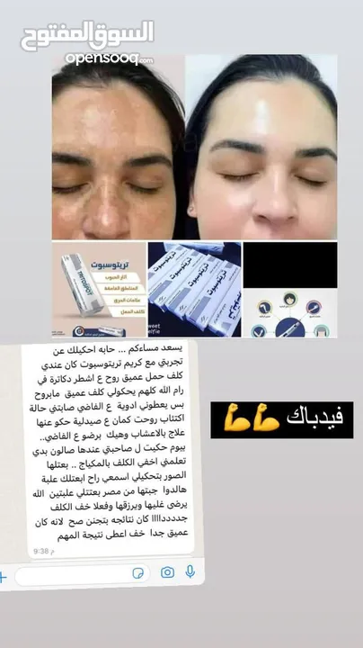 كريم تريتوسبوت الأصلي آمن على البشرة مرخص من وزارة الصحه الفلسطينيه