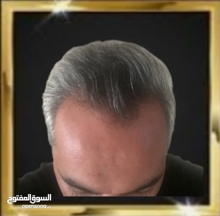 مرکز زراعة الشعر و زراعة احواجب