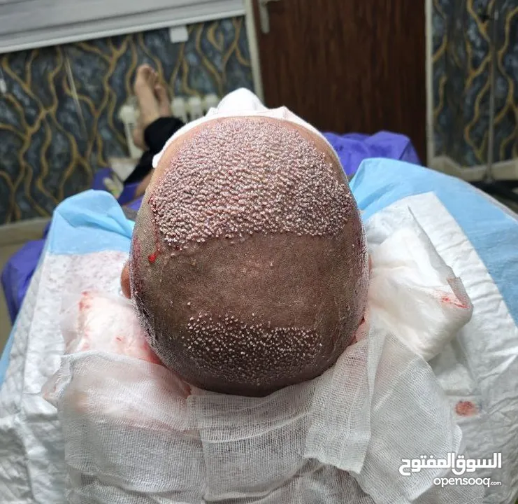 زراعة الشعر الطبيعي في ايران طهران