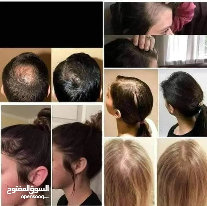 زيت الساسو الهندي لنمو الشعر و تعبئة الفراغات و معالجة الثعلبة و زيادة كثافة الشعر