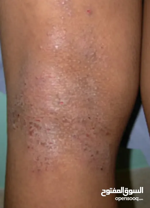 خلطة للتحلص من الاكزيما