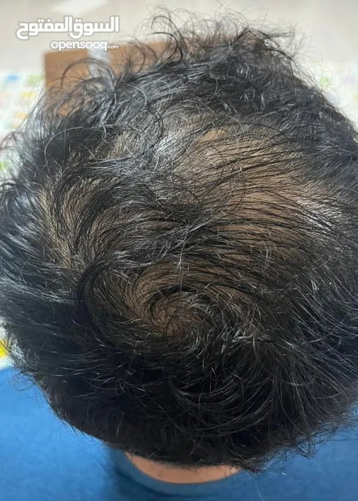 سيروم لعلاج تساقط الشعر ممتاز والنتائج خلال 4 اسابيع فقط