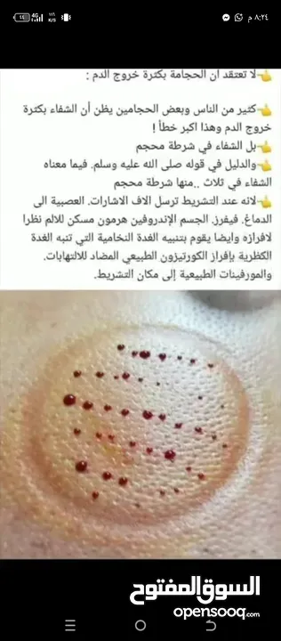 الحجامة للنساء..شفاء الحجامة ليس بكثرة الدم و إنما بالتشريط السليم والطريقة المثلى.. الحجامة وصية ..