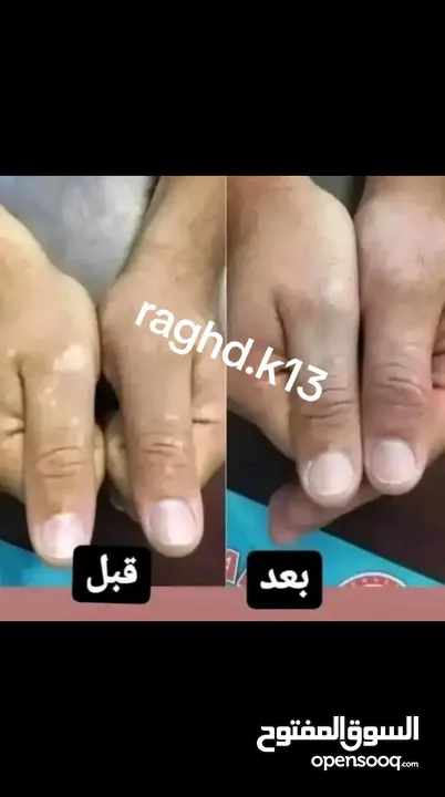 البهاق وطرق علاجيه تساعد بتوحيد لون البشره ومعالجة البهاق
