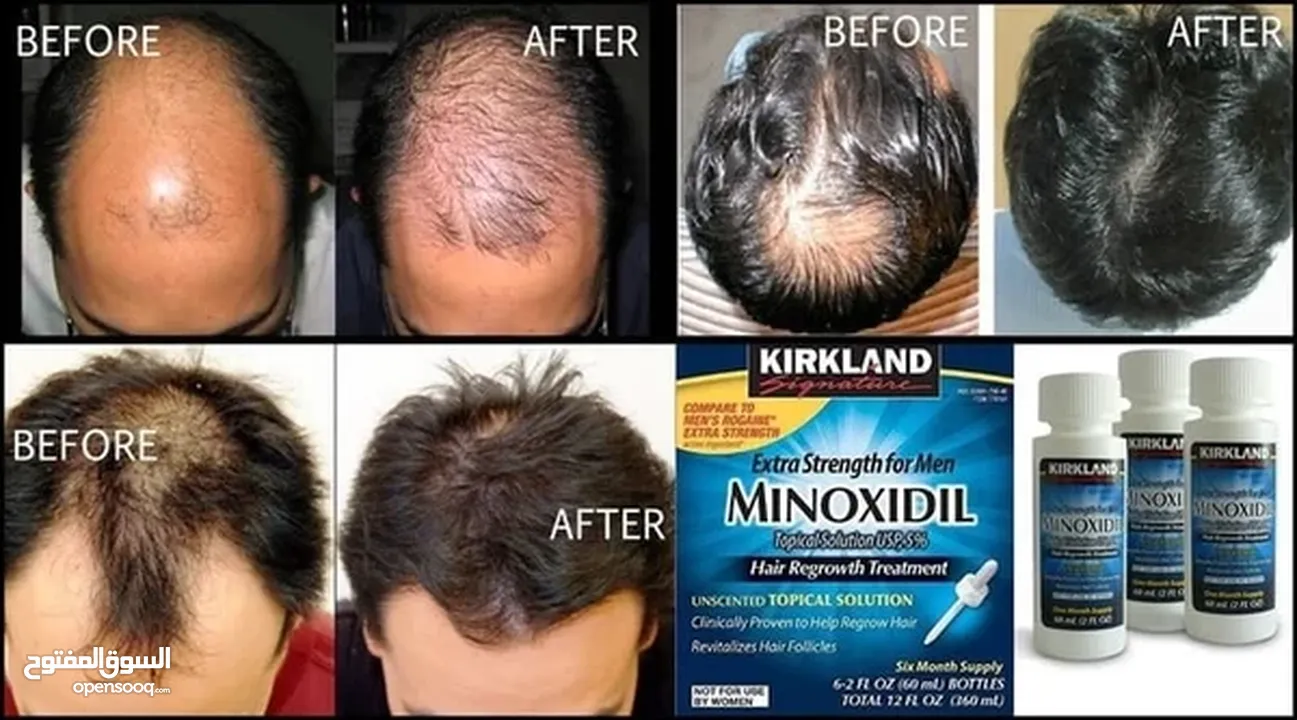 minoxidil منتج منع الصلع ونمو الشعر واللحيه