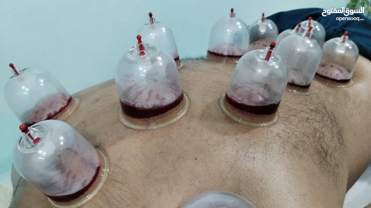 Hijama Cupping Therapy # Wet Cupping Therapy #Cupping Therapy #Hijam in Kuwait #Hijama benefits