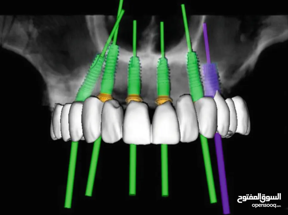 زراعة الاسنان الرقمية ( بدون جراحة بدون الم )