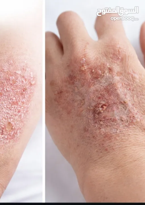 خلطة للتحلص من الاكزيما