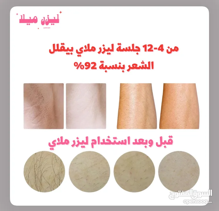 ليزر منزلي لازالة الشعر  ليزر ملاي T3