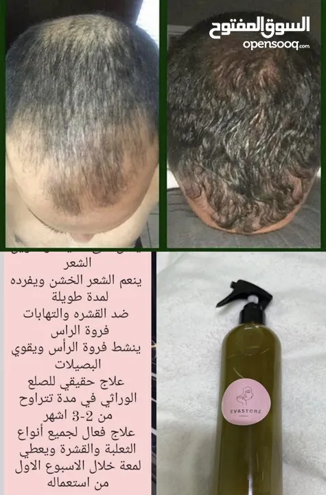 زيوت تكثيف الشعر الطبيعي زيت الصلع وإنبات الشعر