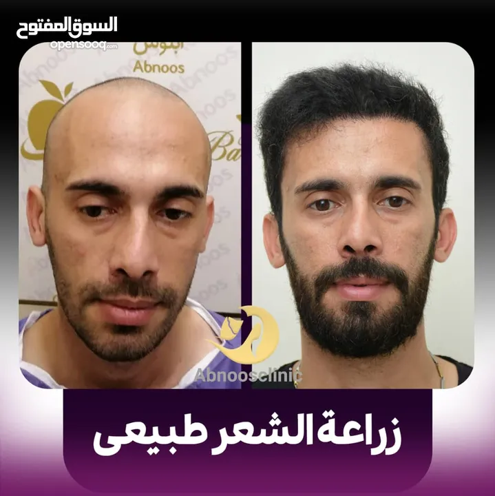 زرع الشعر والتجمیل مرکز  آبنوس مشهد