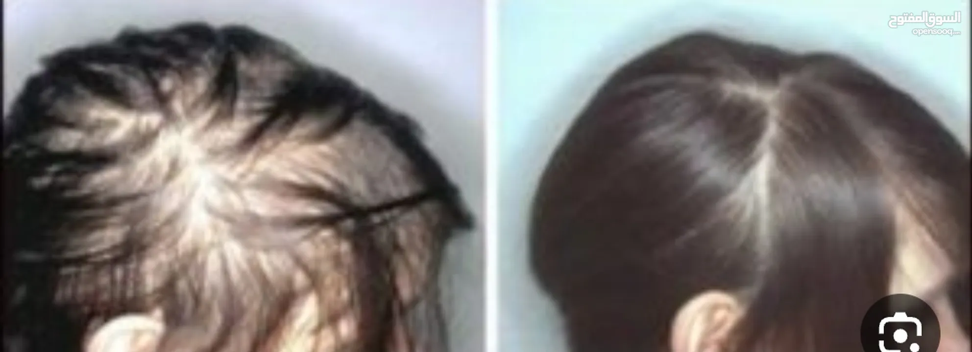 زيت الثعلبة الطبيعي لعلاج الثعلبة وتساقط الشعر