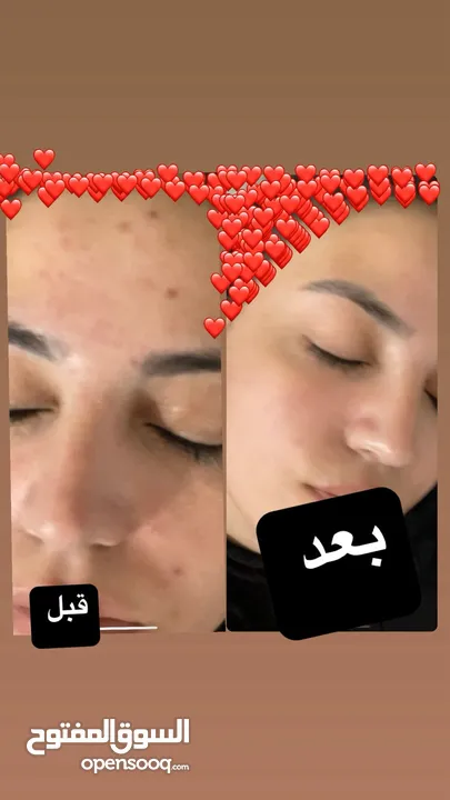 جلسة علاج بشرة