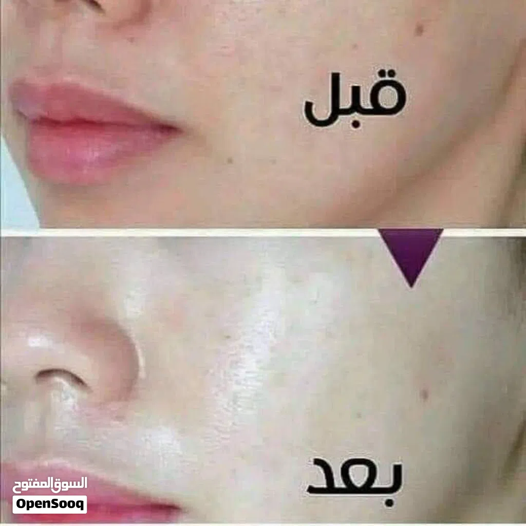 معالج الكلف والنمش والتصبغات واثار الحبوب