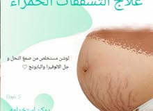 علاج تشققات الجلم الحمراء علاج تشققات الجلم الحمراء