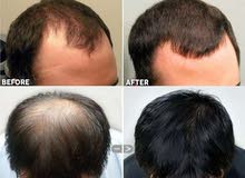 derma roller derma roller