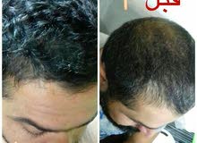 مجموعه تساقط الشعر مجموعه تساقط الشعر