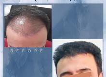 زراعة الشعر زراعة الشعر