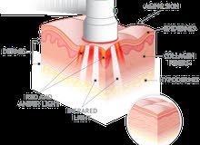 Baby Quasar Device Baby Quasar Device