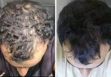 منتوج للقضاء على مشاكل تساقط الشعر منتوج للقضاء على مشاكل تساقط الشعر