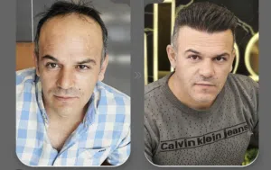 زراعة شعر وحواجب طبيعية