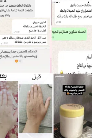 خلطه تناسب الرجال والمساءلات البقع وآثار الحبوب اجمل نتائج التبييض