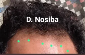 مجموعه انبات الصلعه والجلحات