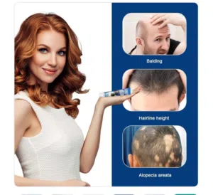 دهان طبيعي لعلاج داء الثعلبة - 20 جرام