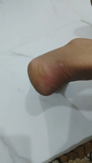 جهاز إزالة الجلد الميت وتشقق القدمين  خلي كعبك ناعم مثل الحرير من أول استخدام