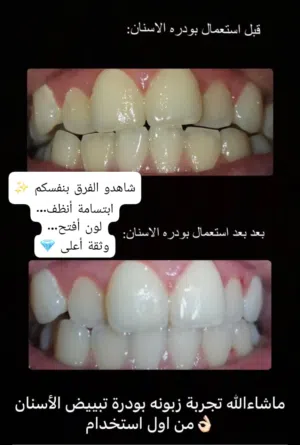 لأن أول شيء يلفت الناس... ابتسامتك! جبت لكم سرّ الأسنان النظيفة والبيضاء