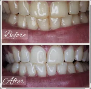 تبيض اسنان منزلي  خدمه منزليه