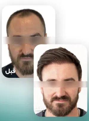 زراعة الشعر
