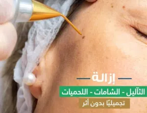 جهاز البلازماج ازالة الثواليل و الوشم الزوائد الجلديه التصبغات جهاز بلازما المحمول بلازماج