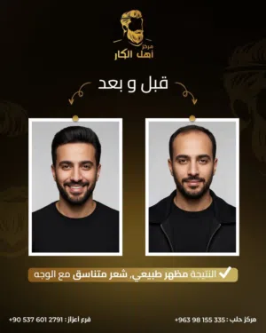 خبراء الشعر البديل وعلاج الصلع في حلب