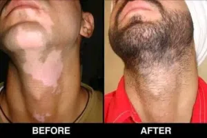 مجموعه طبيعه لعلاج البهاق